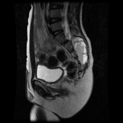 File:Aneurysmal bone cyst - sacrum (Radiopaedia 65190-74196 Sagittal T2 19).jpg
