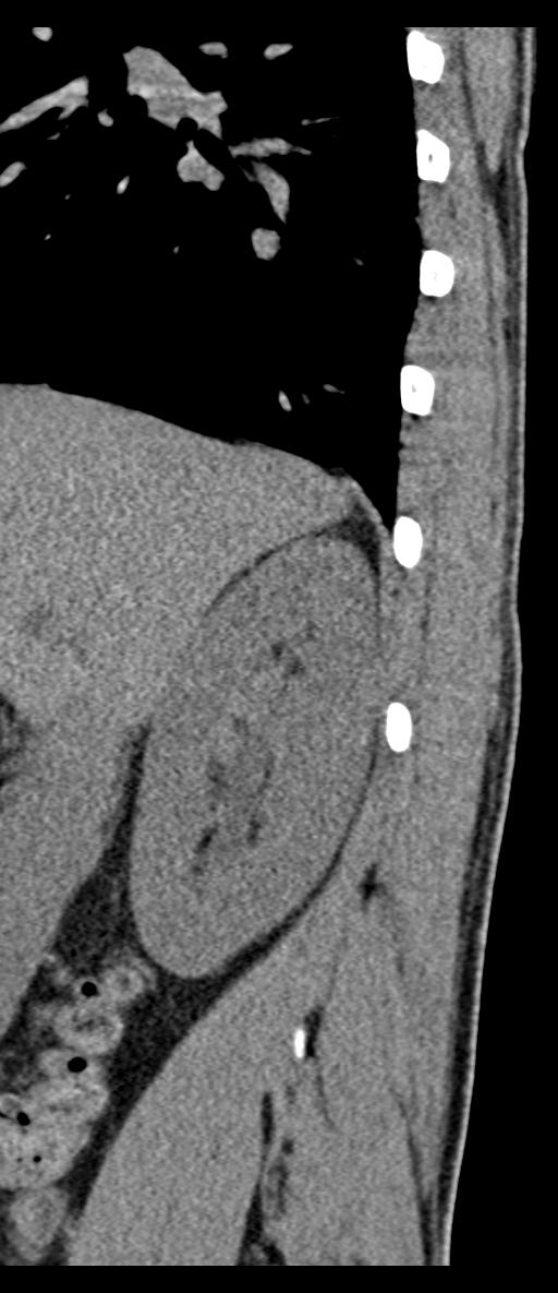 Aneurysmal bone cyst T11 (Radiopaedia 29294-29721 E 77).jpg