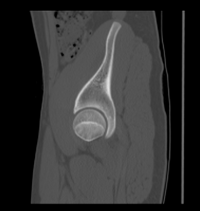 Aneurysmal bone cyst of ischium (Radiopaedia 25957-26094 Sagittal bone window 19).png