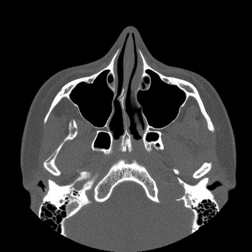 Aneurysmal bone cyst of the mandible (Radiopaedia 43280-46823 Axial bone window 134).jpg