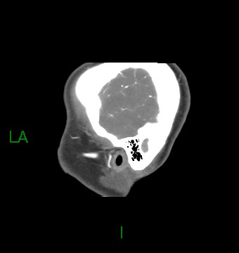 Aneurysmal subarachnoid hemorrhage with intra-axial extension (Radiopaedia 84371-99732 B 64).jpg