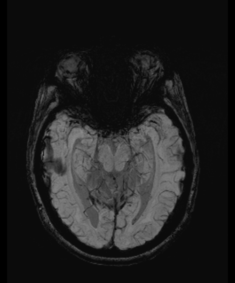 Angiomatous meningioma (Radiopaedia 79459-92579 E 24).jpg