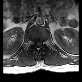 File:Ankylosing spondylitis with zygapophyseal arthritis (Radiopaedia 38433-40516 Axial T1 21).jpg