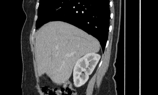 Annular pancreas (Radiopaedia 70359-80453 B 17).jpg