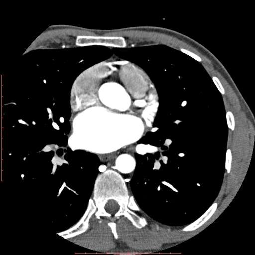 Anomalous left coronary artery from the pulmonary artery (ALCAPA) (Radiopaedia 70148-80181 A 110).jpg