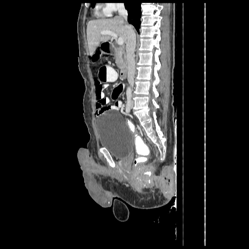 File:Anorectal carcinoma (Radiopaedia 44413-48064 C 48).jpg