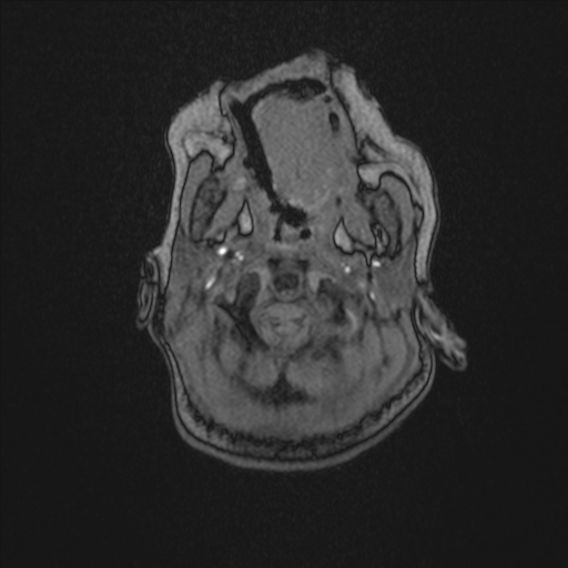 Anoxic brain injury (Radiopaedia 79165-92139 Axial MRA 8).jpg
