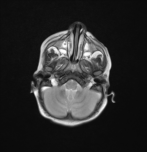 File:Anoxic brain injury (Radiopaedia 79165-92139 Axial T2 6).jpg