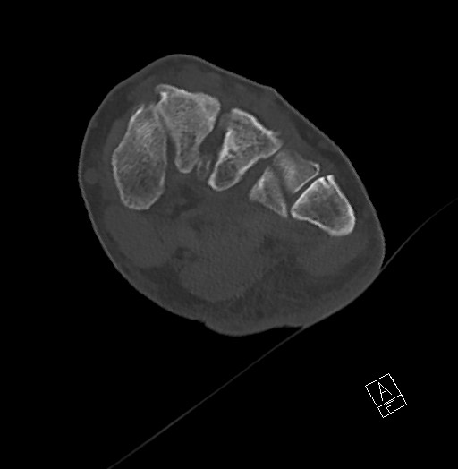 Anterior calcaneal process fracture (Radiopaedia 63353-71943 Axial bone window 79).jpg