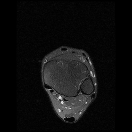 File:Anterior calcaneal process fracture (Radiopaedia 74654-85611 Axial PD fat sat 2).jpg