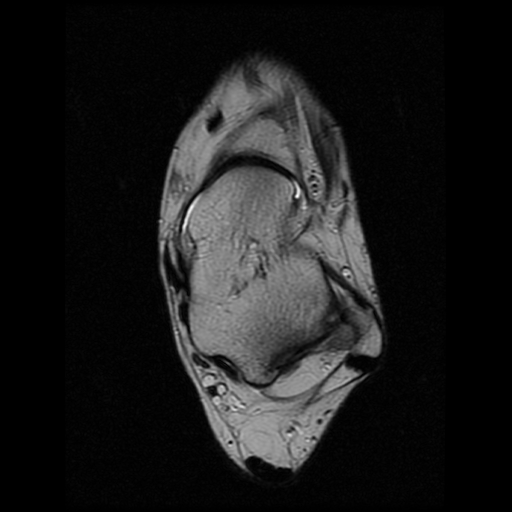 File:Anterior calcaneal process fracture (Radiopaedia 74654-85611 Axial T2 12).jpg