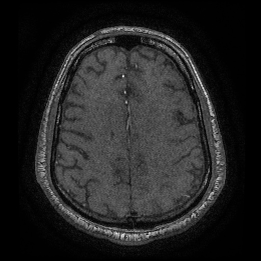 Anterior cerebral artery infarction (Radiopaedia 46794-51323 Axial MRA 172).jpg