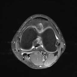 File:Anterior cruciate ligament full thickness tear (Radiopaedia 66268-75467 Axial PD fat sat 16).jpg