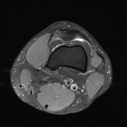 File:Anterior cruciate ligament full thickness tear (Radiopaedia 66268-75467 Axial PD fat sat 5).jpg