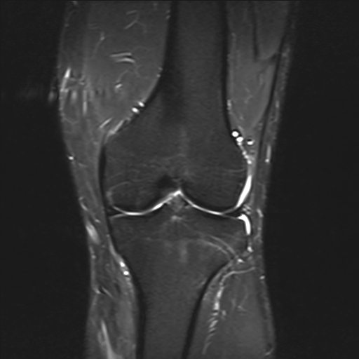 File:Anterior cruciate ligament full thickness tear (Radiopaedia 66268-75467 Coronal STIR 11).jpg