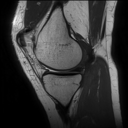 Anterior cruciate ligament rupture and posteromedial corner injury (Radiopaedia 67338-76723 Sagittal PD 57).jpg