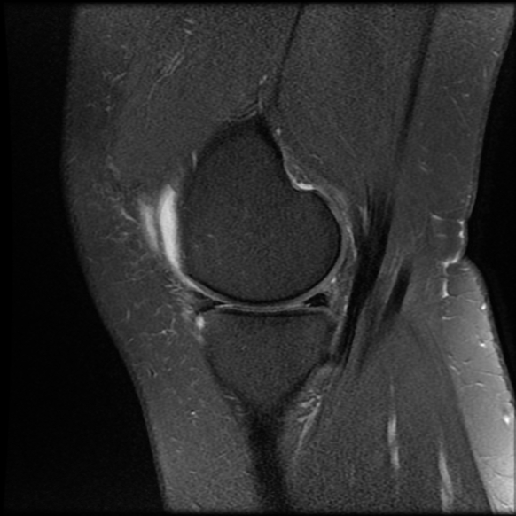 File:Anterior cruciate ligament tear, Wrisberg rip and bucket-handle tear of medial meniscus (Radiopaedia 75872-87266 Sagittal PD fat sat 20).jpg