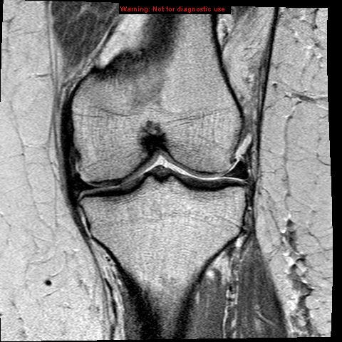 File:Anterior cruciate ligament tear (Radiopaedia 12329-12612 Coronal PD 12).jpg