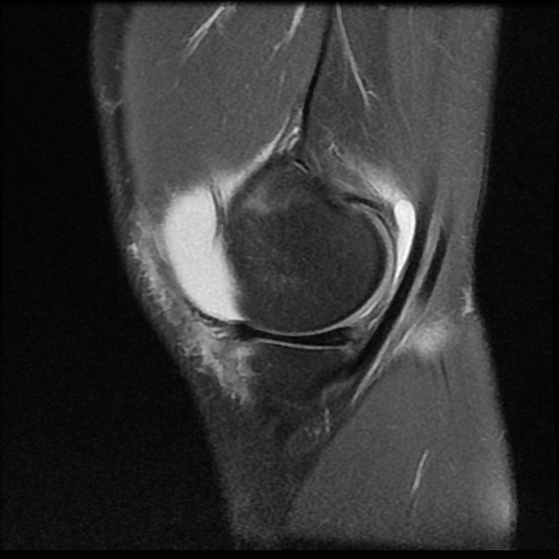 File:Anterior cruciate ligament tear (Radiopaedia 61500-69462 Sagittal PD fat sat 3).jpg