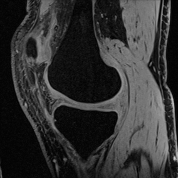 Anterior cruciate ligament tear - ramp lesion (Radiopaedia 71883-82322 Sagittal T1 vibe 93).jpg