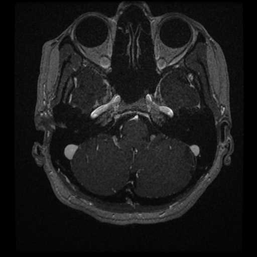 Anterior inferior cerebellar artery vascular loop - type II (Radiopaedia 70991-81209 Axial T1 C+ 65).jpg