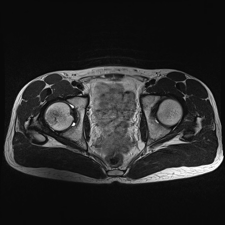 File:Anterior inferior iliac spine avulsion fracture (Radiopaedia 81312-95000 Axial T2 17).jpg