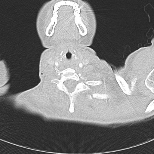Anterior mediastinal lymphoma (Radiopaedia 29556-30061 Axial lung window 1).jpg