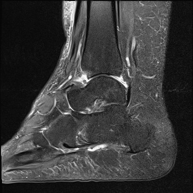 File:Anterior talofibular ligament injury - rupture with soft-tissue impingement (Radiopaedia 38765-40928 Sagittal PD fat sat 9).jpg