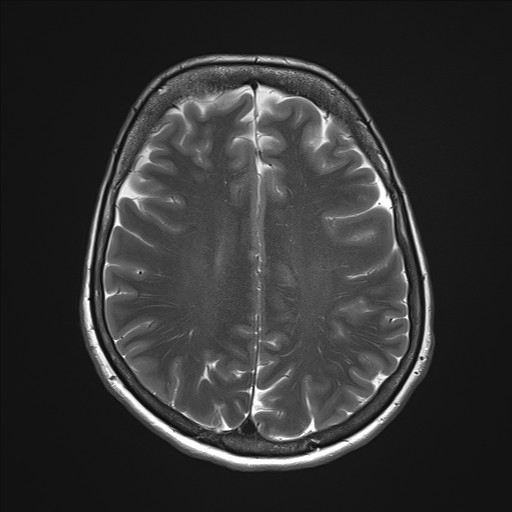 File:Anterior temporal encephalocele (Radiopaedia 82624-96808 Axial T2 26).jpg