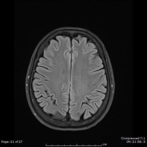 File:Anterior temporal lobe perivascular space (Radiopaedia 88283-104914 Axial FLAIR 21).jpg
