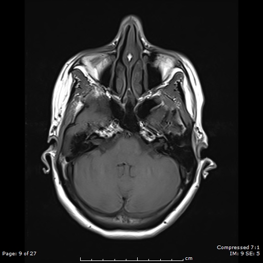 File:Anterior temporal lobe perivascular space (Radiopaedia 88283-104914 Axial T1 9).jpg