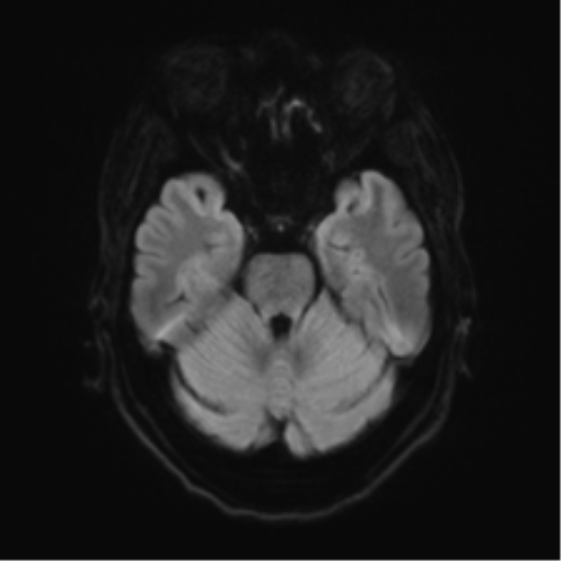Anterior temporal pole cysts (Radiopaedia 46629-51102 Axial DWI 36).png