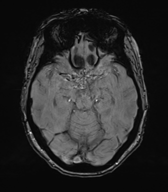Anterior temporal pole cysts (Radiopaedia 46629-51102 Axial SWI 36).png