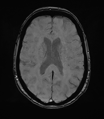 Anterior temporal pole cysts (Radiopaedia 46629-51102 Axial SWI 53).png