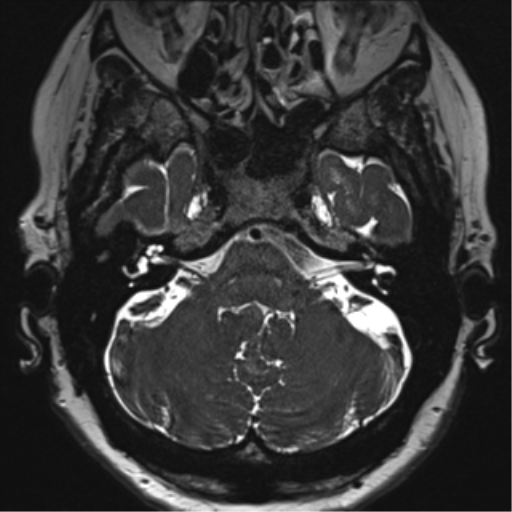 Anterior temporal pole cysts (Radiopaedia 46629-51102 Axial T2 30).png