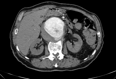 File:Anterior vertebral scalloping (abdominal aortic aneurysm) (Radiopaedia 66744-76067 F 23).jpg