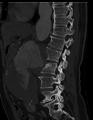 File:Anterior vertebral scalloping (abdominal aortic aneurysm) (Radiopaedia 66744-76067 Sagittal bone window 22).jpg