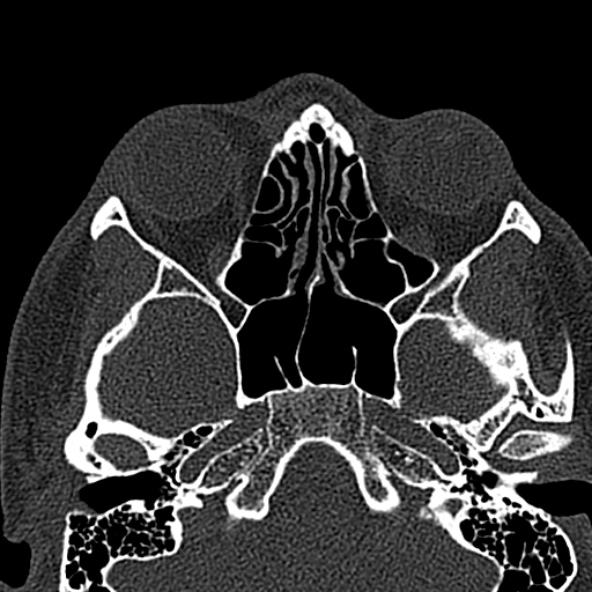 Antrochoanal polyp (Radiopaedia 30002-30554 Axial bone window 36).jpg