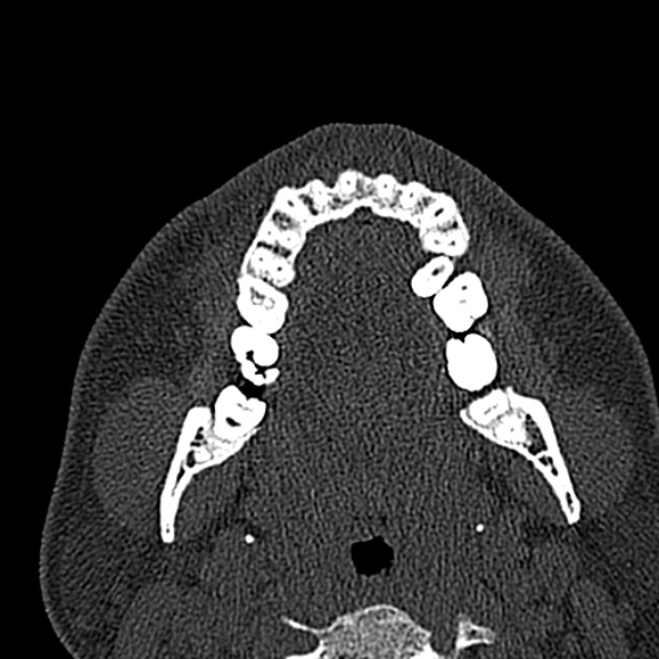 Antrochoanal polyp (Radiopaedia 30002-30554 Axial bone window 8).jpg