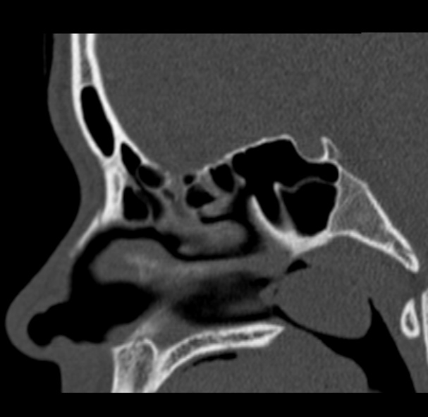 Antrochoanal polyp (Radiopaedia 33984-35202 Sagittal bone window 44).jpg