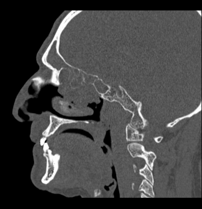 Antrochoanal polyp (Radiopaedia 79011-92169 Sagittal bone window 41).jpg