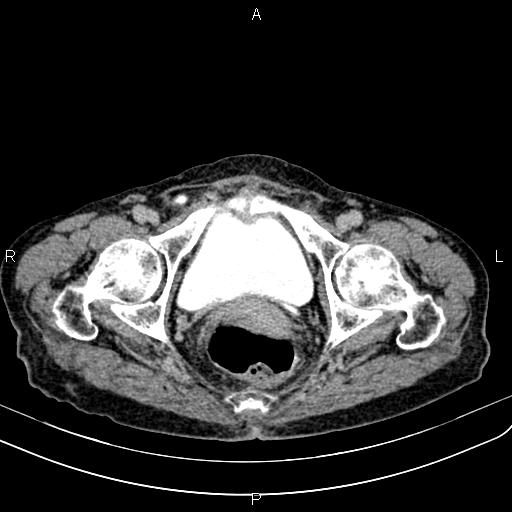 File:Aortic aneurysm and Lemmel syndrome (Radiopaedia 86499-102554 Axial C+ delayed 75).jpg