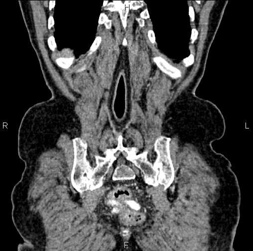 Aortic aneurysm and Lemmel syndrome (Radiopaedia 86499-102554 C 59).jpg