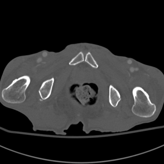 Aortic aneurysm with spinal destruction (Radiopaedia 42301-45410 Axial bone window 118).jpg