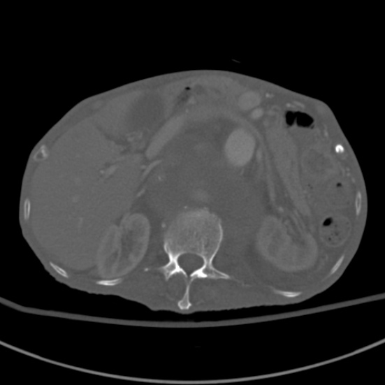 Aortic aneurysm with spinal destruction (Radiopaedia 42301-45410 Axial bone window 31).jpg