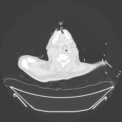 Aortic arch aneurysm (Radiopaedia 84109-99365 Axial lung window 2).jpg