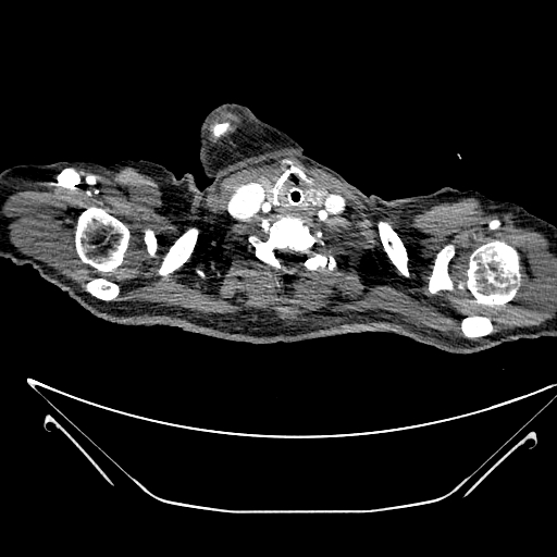File:Aortic arch aneurysm (Radiopaedia 84109-99365 B 10).jpg