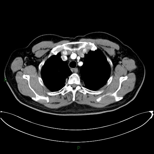 Aortic arch origin of left vertebral artery (Radiopaedia 46327-50737 Axial post contrast 25).jpg