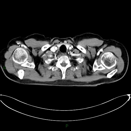 Aortic arch origin of left vertebral artery (Radiopaedia 46327-50737 Axial post contrast 8).jpg