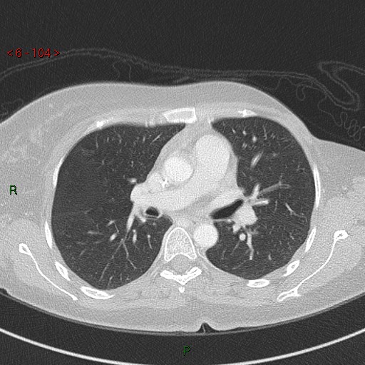 Aortic arch origin of left vertebral artery (Radiopaedia 51520-57286 Axial lung window 104).jpg